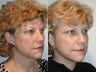Deep Plane Facelift - Endoscopic Forehead Lift