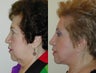 Composite Facelift, Upper and Lower Blepharoplasty