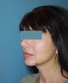 Facelift