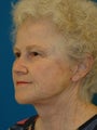 Lower Facelift and Necklift with Platysmaplasty