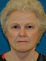 Lower Facelift and Necklift with Platysmaplasty