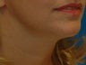 Lower Facelift with Submental Liposuction (Liposuction under the chin)