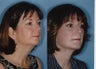 Facelift