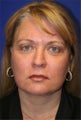 Facelift and Necklift