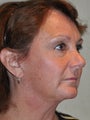 Facelift