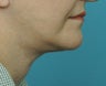 Facelift