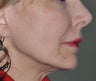 Facelift