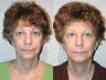 Sluplift Mini-Neck & Jowl Lift