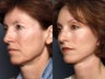 Facelift