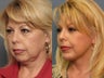 Facelift
