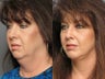 Facelift