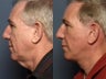 Facelift