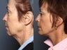 Facelift