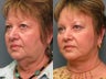 Facelift