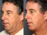Facelift