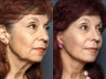 Facelift
