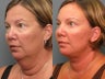 Facelift