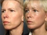 Facelift