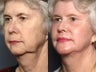 Facelift