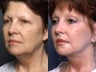 Facelift