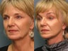 Facelift