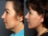 Facelift