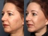 Facelift