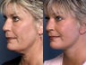 Facelift