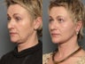 Facelift