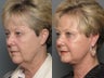 Facelift