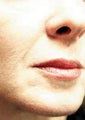 Facial Fillers