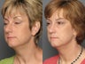 Face Lift Surgery