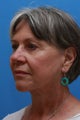 Facelift with Facial Fat Transfer