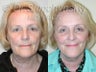 Sluplift Mini Neck & Jowl Lift & Lower Blepharoplasty