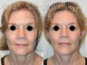 SLUPlift Neck & Jowl Lift