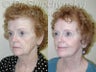 SLUPlift Neck & Jowl Lift