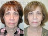 SLUPlift Neck & Jowl Lift