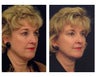 Full Facial Rejuvenation