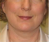 Face Lift