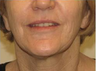 Face Lift, Fat grafrting, TCA Peel