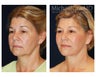 Facial Rejuvenation