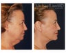 Facial Rejuvenation