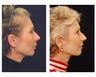 Facial Rejuvenation