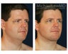 Facial Rejuvenation