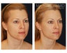 Facial Rejuvenation