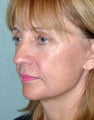 FaceLift