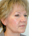 Facelift
