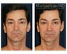 Facial Rejuvenation - Eyelid Surgery