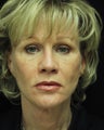 facelift, forehead lift, blepharoplasty