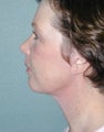 FaceLift
